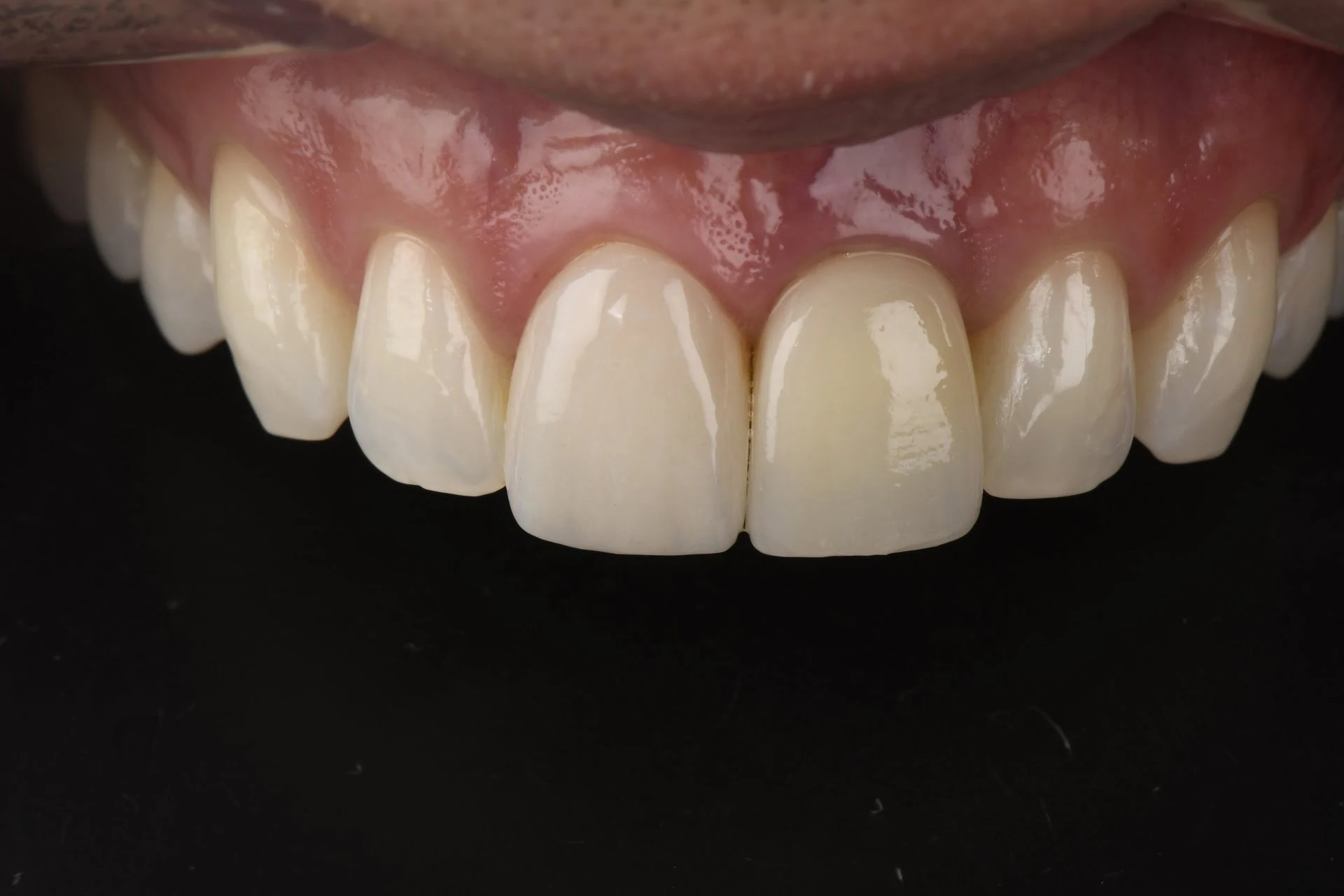 Restorative dental result