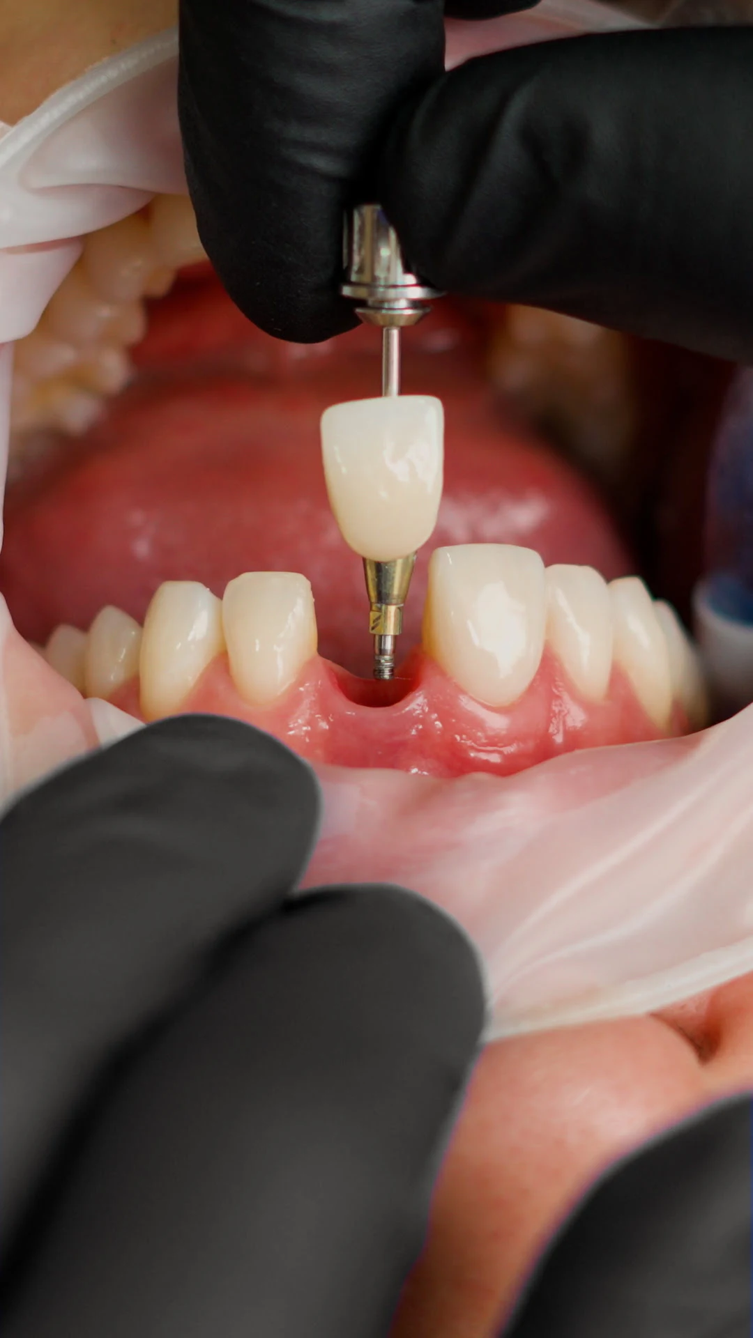 Dental implant procedure
